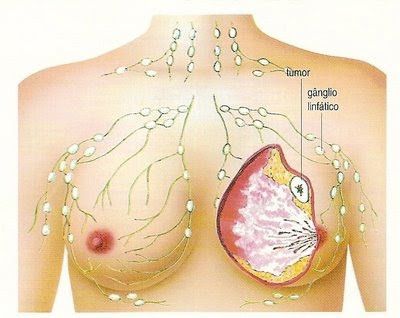 Tratamentos e efeitos colaterais do câncer de mama