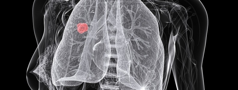 Comitê SBOC comenta estudos sobre rastreamento de câncer de pulmão
